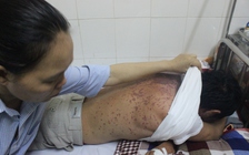 Nhập viện sau khi ăn cá nục kho và uống thuốc hen suyễn