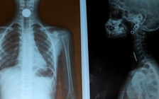 Mải chơi đùa, bé gái 9 tuổi hóc đồng xu