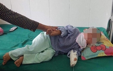 Cháu bé 4 tuổi bị chó cắn trọng thương mặt đã ổn định sức khoẻ