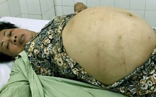 Mổ thành công cho nữ bệnh nhân có khối u buồng trứng nặng 20 kg