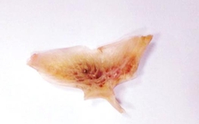 Cứu người đàn ông bị hóc mảnh xương cá ngát lớn