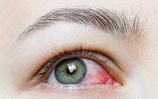 Ngày mới với tin tức sức khỏe: Chưa có bằng chứng khẳng định Covid-19 lây qua mắt