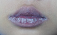 Nhiễm Omicron, thấy dấu hiệu này ở môi cần cấp cứu ngay