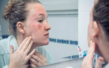 Ngày mới với tin tức sức khỏe: Dấu hiệu ung thư có thể xuất hiện trên mặt