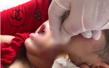 Cháu bé 19 tháng tuổi đang ngồi chơi trong nhà, bị chó dại tấn công