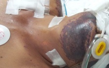 Không ăn tiết canh, không giết mổ lợn sao vẫn nhiễm liên cầu lợn?