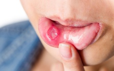 Ngày mới với tin tức sức khỏe: Vết loét miệng không lành là dấu hiệu bệnh gì?