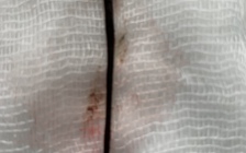 Rửa mặt ở khe suối, bị con đỉa dài 4 cm chui vào mũi