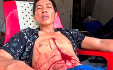 Thanh niên bị bắn vào ngực nhưng 'thà chết không đi bệnh viện'