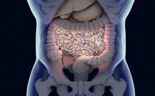 Cấy phân để chữa cho người đàn ông 'không uống rượu mà say xỉn'