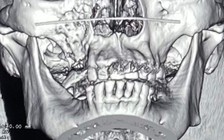 Hoại tử xương sọ - mặt trên bệnh nhân từng mắc Covid-19: Đề nghị nơi tiếp nhận hội chẩn, báo cáo