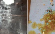 Hơn 1 kg đinh, ốc vít trong dạ dày của một người cai rượu