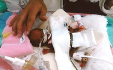 'Phép màu' y học: nuôi sống bé trai sinh non chỉ nặng 258 g