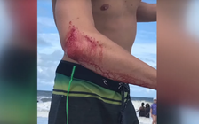 Bị cá mập tấn công, thanh niên không đến bệnh viện mà tới thẳng quán nhậu