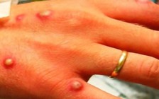 Mỹ cảnh báo đậu mùa khỉ đã âm thầm lây lan từ lâu