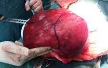 Mổ lấy thành công khối u nặng hơn 6 kg trong bụng bệnh nhân