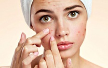 Những quan niệm sai về chăm sóc da mụn