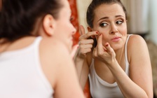 5 bí quyết đánh bay mụn trứng cá