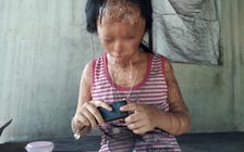 Bi kịch người lớn đánh ghen tạt axít: Cảnh mù lòa đau đớn của con trẻ