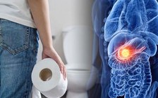 5 triệu chứng đầu tiên để nhận biết ung thư ruột chết người