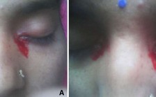 Kỳ lạ cô gái cứ 'đến tháng' là khóc ra máu