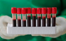 Người thuộc nhóm máu nào dễ bị ung thư nhất?