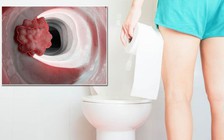 Nhìn thấy phân có hình dạng này, mau đi khám ung thư ruột