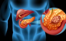 Đây là 2 loại ung thư nguy hiểm nhất