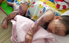 TP.HCM kiểm tra dịch bệnh tay chân miệng trong trường học