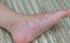 Bệnh tay chân miệng dễ lầm với nhiều bệnh khác