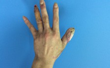 Lần đầu tiên vi phẫu ghép móng chân làm móng tay