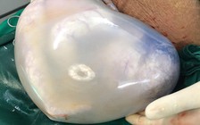 Nóng trên mạng xã hội: Ngỡ ngàng cặp song sinh nằm trong bọc ối hình trái tim