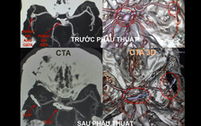 Cứu sống bệnh nhân bị vỡ túi phình mạch máu não kích thước lớn