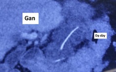 Nuốt nhầm xương cá, xương nhọn xuyên thủng dạ dày, đâm vào gan