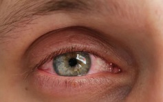 Đau mắt đỏ có thể tự khỏi không?
