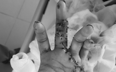 Trả lại bàn tay lành lặn cho bệnh nhân bị đứt lìa 2 ngón tay