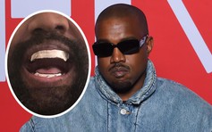Kanye West gắn hàm răng giả hơn 20 tỉ đồng