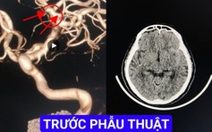 Cứu bệnh nhân bị xuất huyết dưới nhện do vỡ túi phình động mạch não