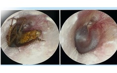 Suýt bị điếc do con gián chui vào tai khi đang ngủ