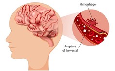 Loại rau chống ung thư được phát hiện trị cả đột quỵ