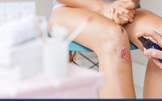 Bị té xe trầy chân nên làm gì để vết thương mau lành và ngừa sẹo xấu?