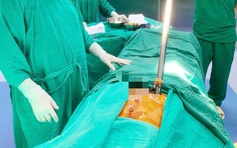 Phẫu thuật thành công cho bệnh nhân bị xà beng đâm xuyên bụng