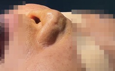 Mũi người phụ nữ bị biến dạng co rút, gây khó thở sau 7 lần sửa