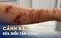 Sứa biển tấn công, đừng chủ quan!