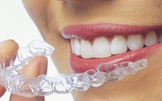 Niềng răng Invisalign: Hành trình ‘lột xác’ nụ cười cùng Nha khoa quốc tế Phú Hòa