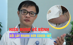 Dịch sởi có lây lan nhanh hơn Covid-19? - Hiểu đúng về bệnh