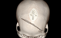 Vỡ sọ, dập não sau xô xát, nam thanh niên được cứu sống đầy ngoạn mục