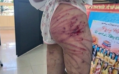 Bé gái 11 tuổi nhập viện, nghi bị cha dượng bạo hành