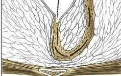 Bệnh tổ lông vùng cùng cụt