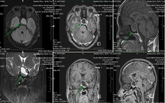 Khát nước dữ dội, bệnh gì?